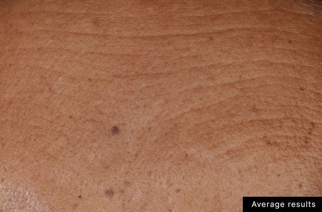 After treatment