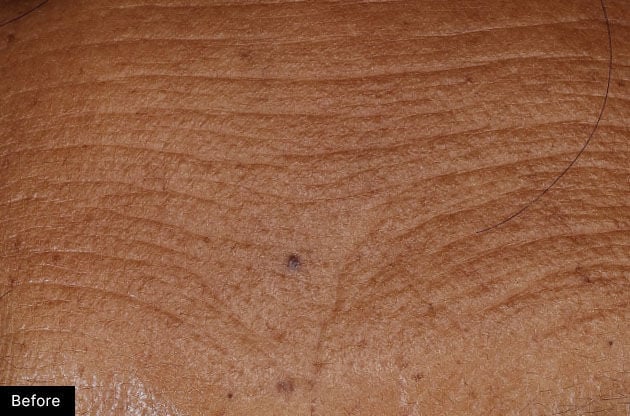 Before treatment