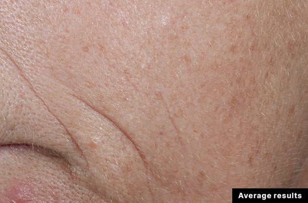 After treatment