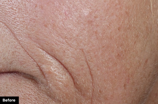Before treatment