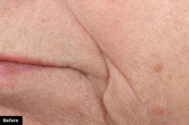 Before treatment