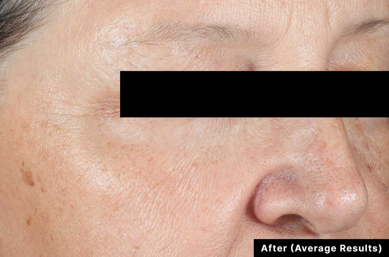 After treatment