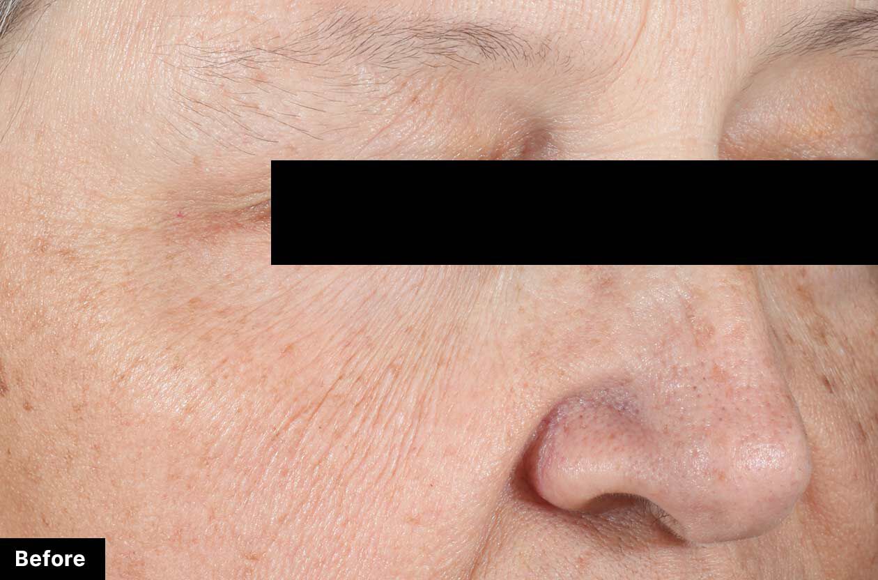 Before treatment